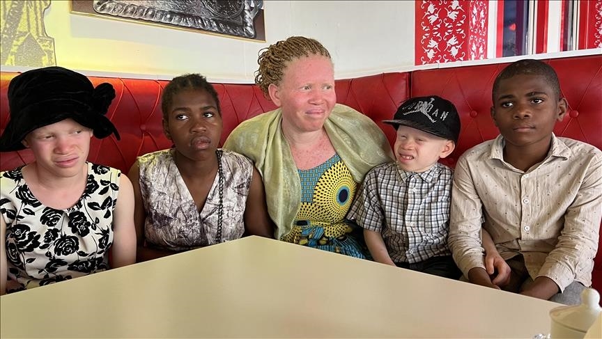 Pessoas com albinismo na Huíla beneficiam de consultas gratuitas